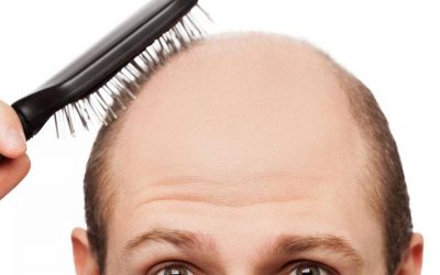 Alopecia, enfermedad del Siglo XXI