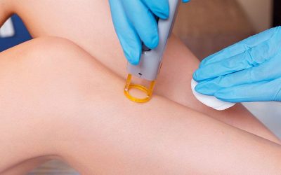 Sesiones depilación láser de piernas