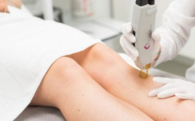 El láser para una depilación permanente