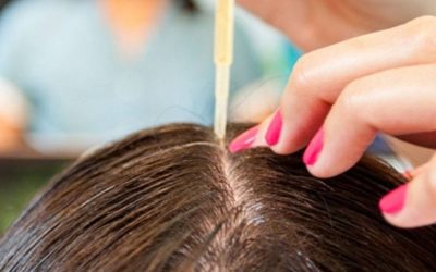 Minoxidil y Finasterida