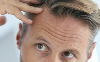 Tipos de Alopecias No Cicatriciales