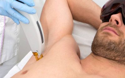 Depilación con láser médico